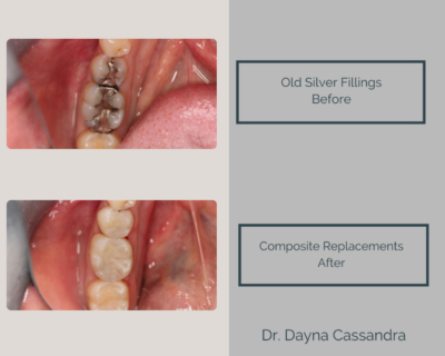 Replacing silver filings with composite fillings
