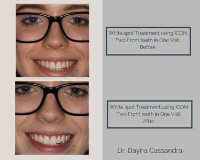 White spot treatment using ICON on two front teeth in one visit