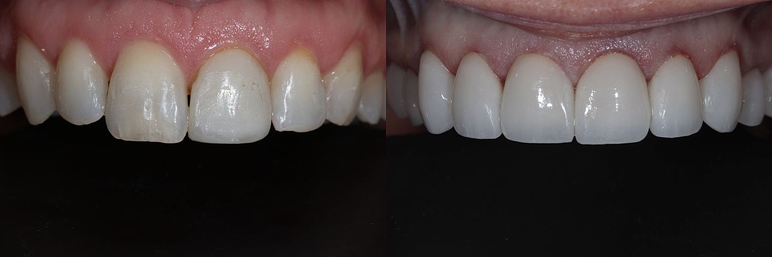 Before and after dental treatment comparison.