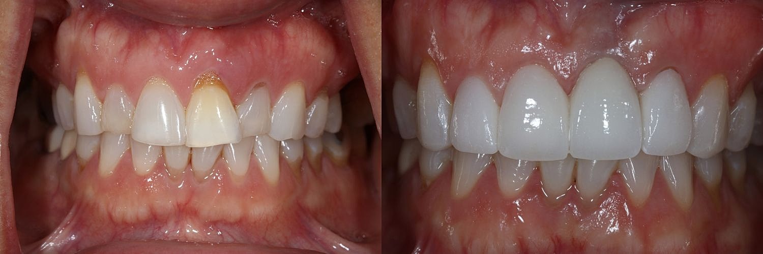 Before and after dental treatment comparison.