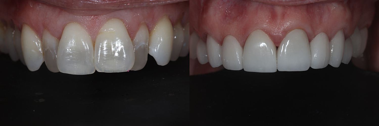 Before and after dental treatment comparison.