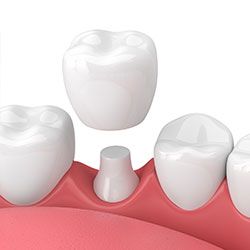 Dental crown placement on artificial tooth model