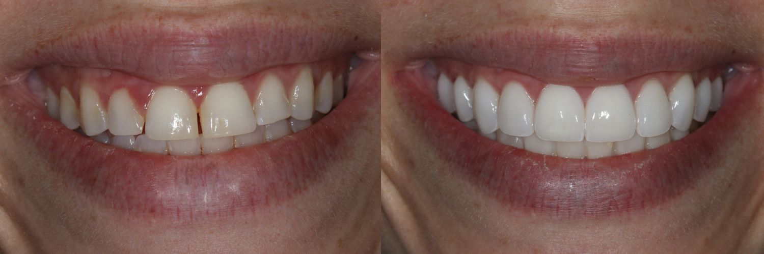 Before and after teeth comparison.