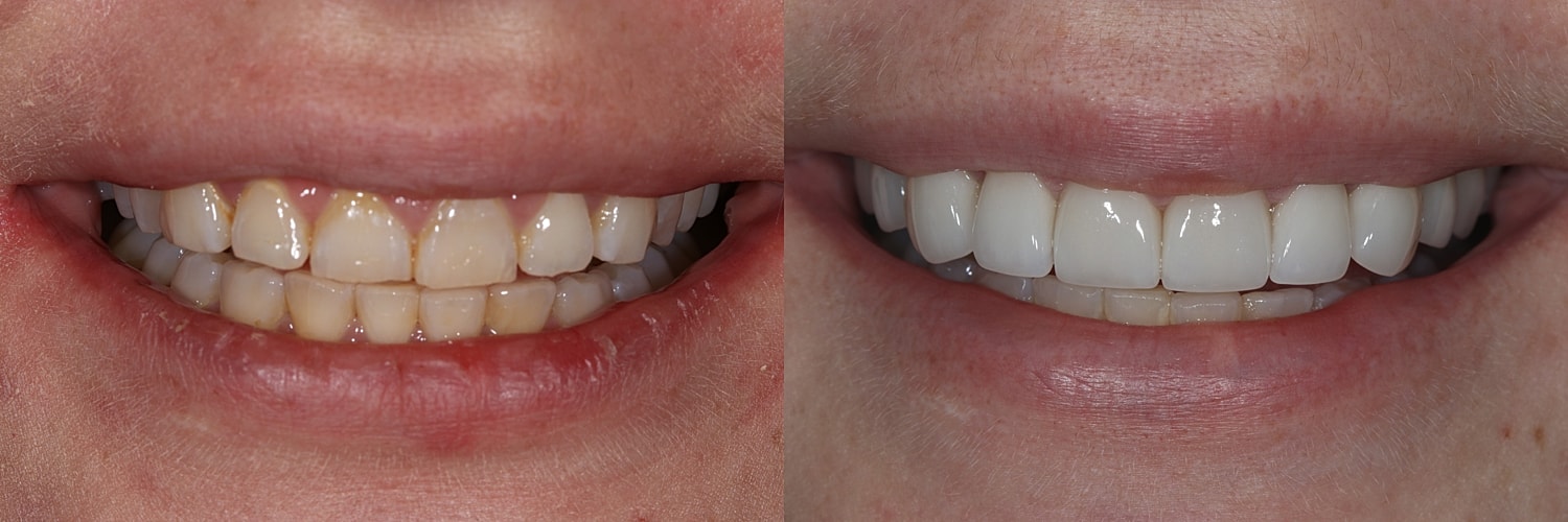 Before and after teeth whitening comparison.