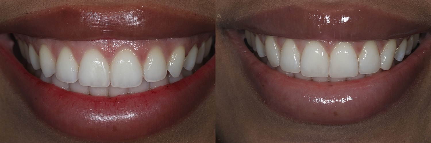 Before and after teeth whitening results.