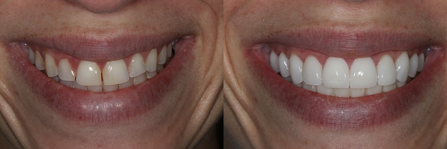 Before and after teeth whitening comparison.