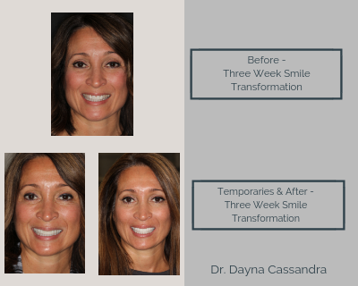 Three Week Smile Transformation